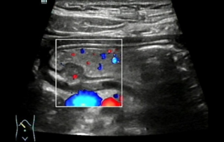 Ultrasound Journal 5 - A Hidden World Under the Mucosa - A Case Report of Ectopic Pancreas in the Stomach Wall by Ultrasonography