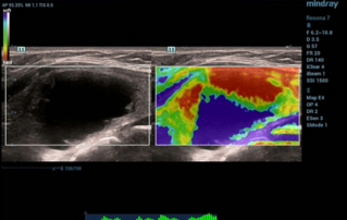 Ultrasound Journal 16 - Application of ultrasound-guided sclerotherapy in patients with focal cystic thyroid mass