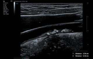 Ultrasound Journal 40 - Carotid Plaque: Conventional and Innovation Technique