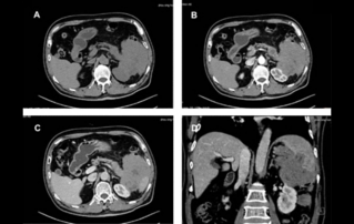Ultrasound Journal 7 - CEUS of Rare Primary Pancreatic Lymphoma