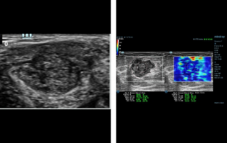 Ultrasound Journal 11 - Complementary use of Shearwave Elastography with shell assessment prior to biopsy in the evaluation of Breast mass lesions- Clinical Value
