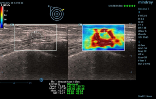 Ultrasound Journal 24 - Multiparametric ultrasound in differential diagnosis of breast mass