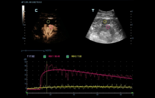 Ultrasound Journal 12 - Multiparametric Ultrasound in Differentiating a Complex Cystic Renal Mass: A Case Report 