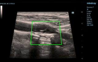 Ultrasound Journal 23 - Postoperative Ultrasound: A Case Study in Cardiovascular Pathology