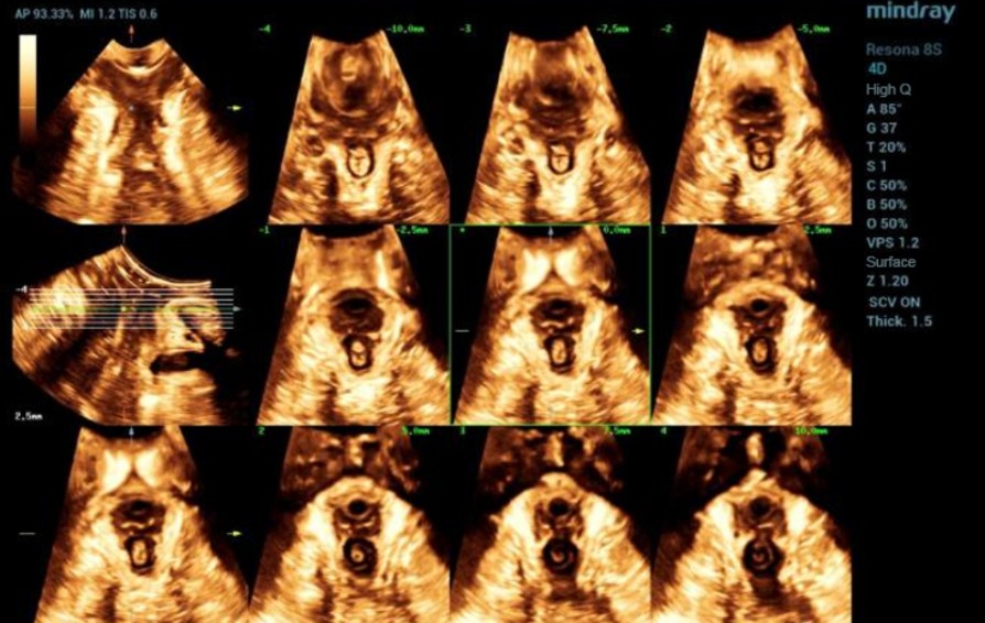 Ultrasound Journal 2 - The Levator Trauma in Childbirth