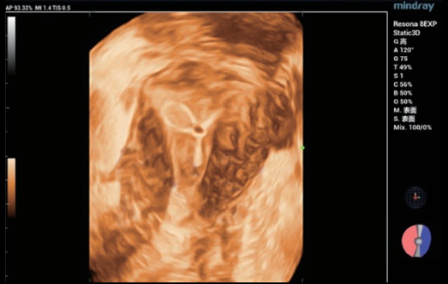 Ultrasound Journal 4 - Ultrasound Assessment of Intrauterine Device (IUD)