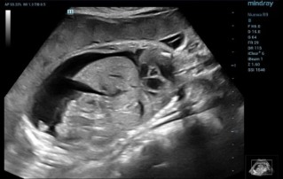 Fetal Ultrasound On Ribs Ultrasound Registry Review General