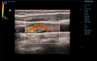 Ultrasound Journal 13 - Ultrasound Diagnostics with Carotid-Web Using V Flow Technology