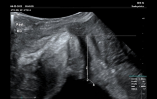 Ultrasound Journal 21 - Ultrasound Evaluation of Stress Urine Continence in Patients Who Not Require Immediate Surgical Treatment