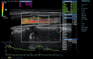 Ultrasound Journal 22 - V Flow Doppler Patterns of Carotid Atherosclerotic Plaques