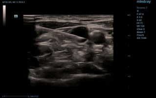 Ultrasound Journal 20 - Features of Subcutaneous Venous Port Systems Implantation Using Ultrasound Marking and Ultrasound Navigation