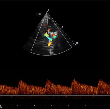 Doppler Ultrasound: Many Shades of Color