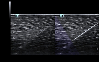 Mindray Introduces Specialized Transducer and Enhanced iNeedle on TE7 Touch Enabled Ultrasound System for Anesthesia Applications