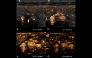 Ultrasound Journal  - Glomus carotideo, presentación de un caso con diagnóstico por ultrasonido multiparamétrico e imagen multimodal