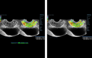 Ultrasound Journal 8: 전립선 질환 진단에 다변수(multiparametric) 초음파 사용 사례