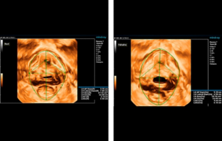 Ultrasound Journal 9 - 여성 생식기 탈출(genital prolapse) 수술 전 여성의 잠재 요실금 검출