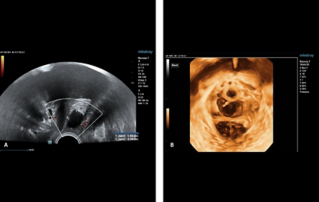Ultrasound Journal 10 - 질전벽(anterior vaginal wall) 자궁내막낭종(Endometrioid cyst)