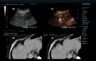 Ultrasound Journal 1: Mindray "Fusion imaging"을 활용한 재발성 간암 Micowave Ablation 케이스 리뷰 