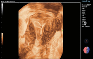 Ultrasound Journal 4 - 자궁 내 장치 초음파 검사
