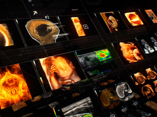 超声智能应用，让更多女性享有高质高效的超声诊断